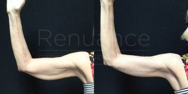 Renuance - Brachioplasty by Michael Hill, MD