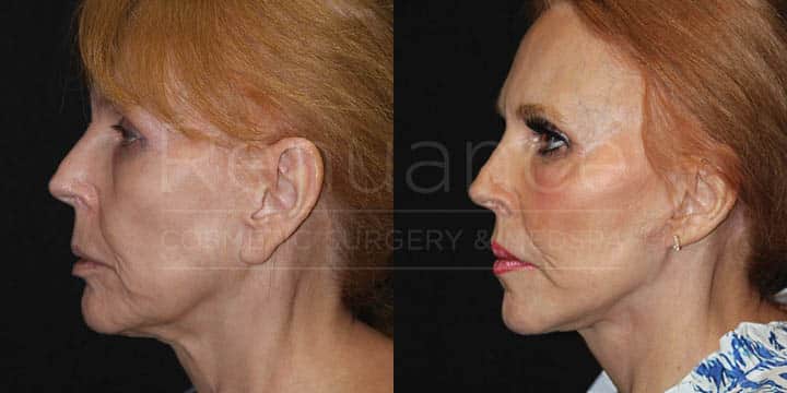 Renuance - CO2 Resurfacing, AFT, and Earlobe Reduction by Michael Hill MD