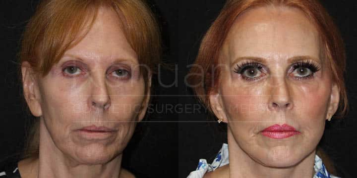 Renuance - CO2 Resurfacing, AFT, and Earlobe Reduction by Michael Hill MD