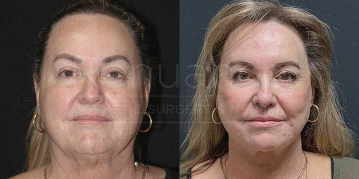 Renuance - Deep Plane Facelift, Neck Lift, Brow Lift, Fat Grafting by Michael Hill MD