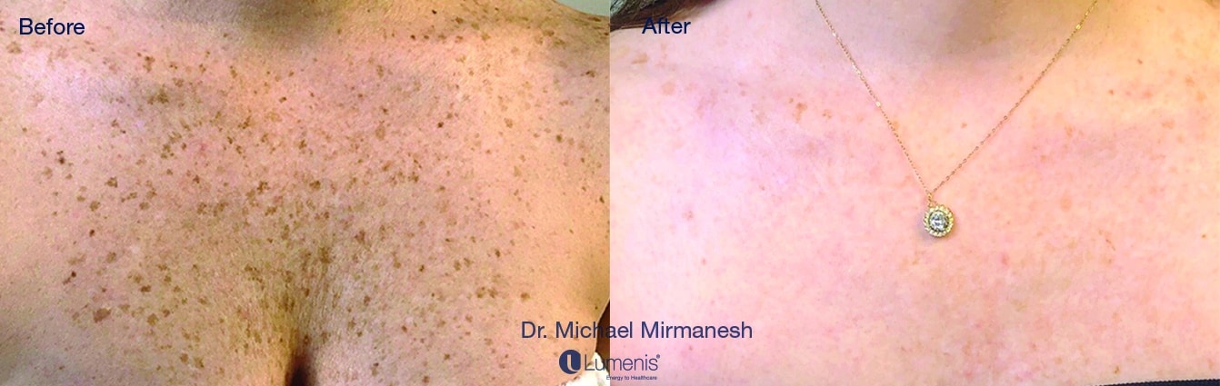 before and after laser treatments