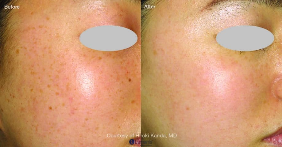 before and after laser treatment with stellar m22