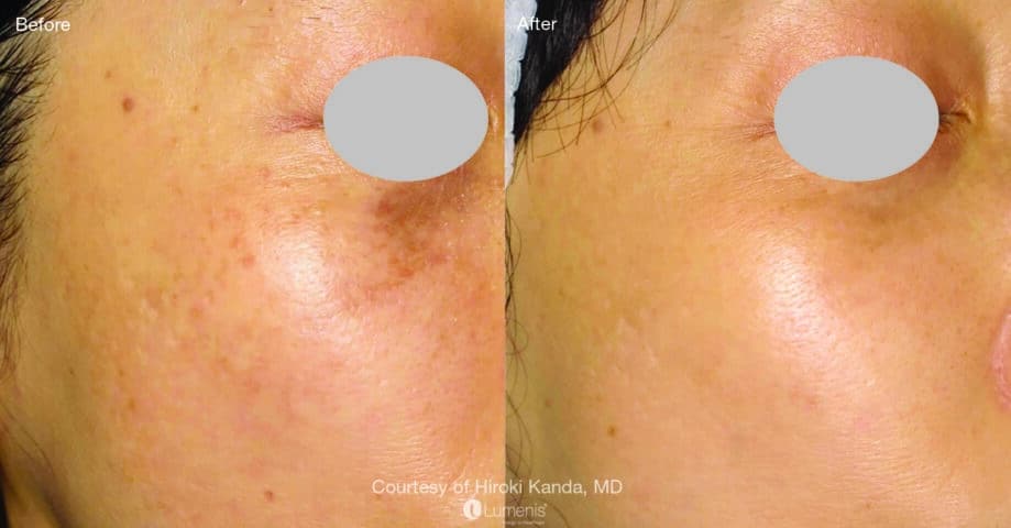 before and after laser treatment for skin pigmentation