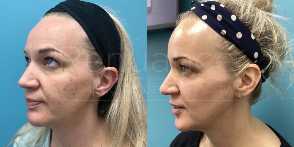 before and after ipl photofacial in murietta