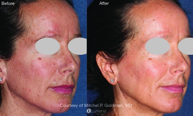before and after laser treatment for skin texture