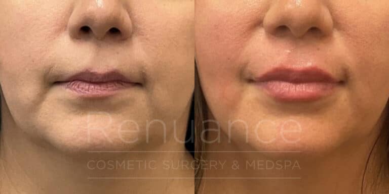 before and after lip filler