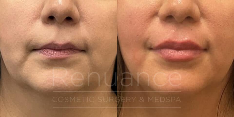 before and after lip filler