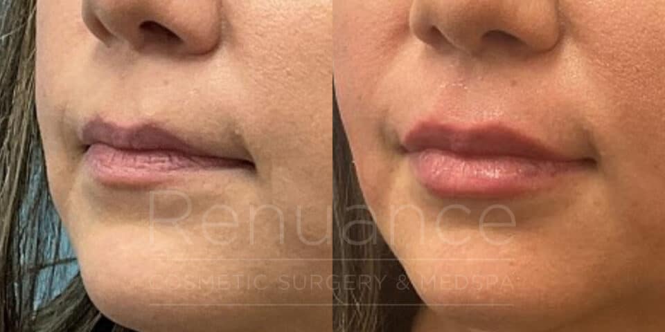 before and after lip filler
