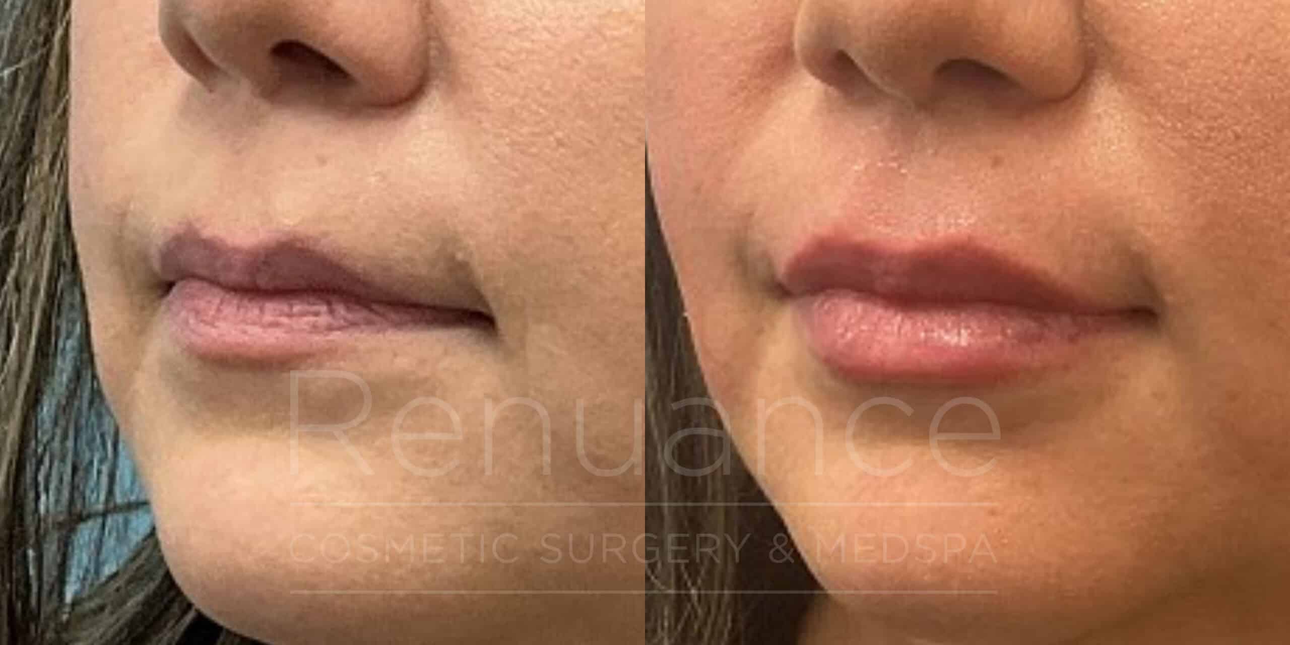 before and after lip filler