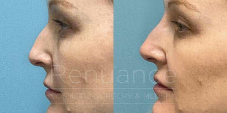 before and after liquid rhinoplasty