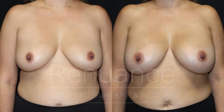 breast augmentation before and after