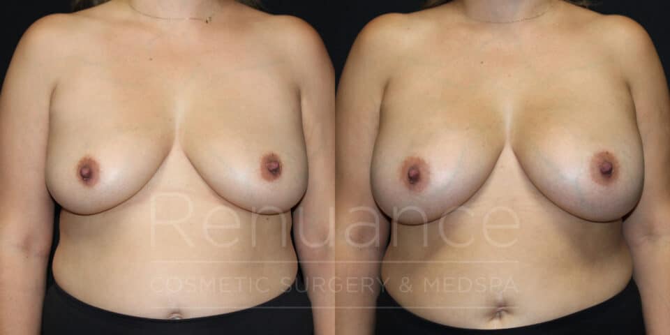 breast augmentation before and after