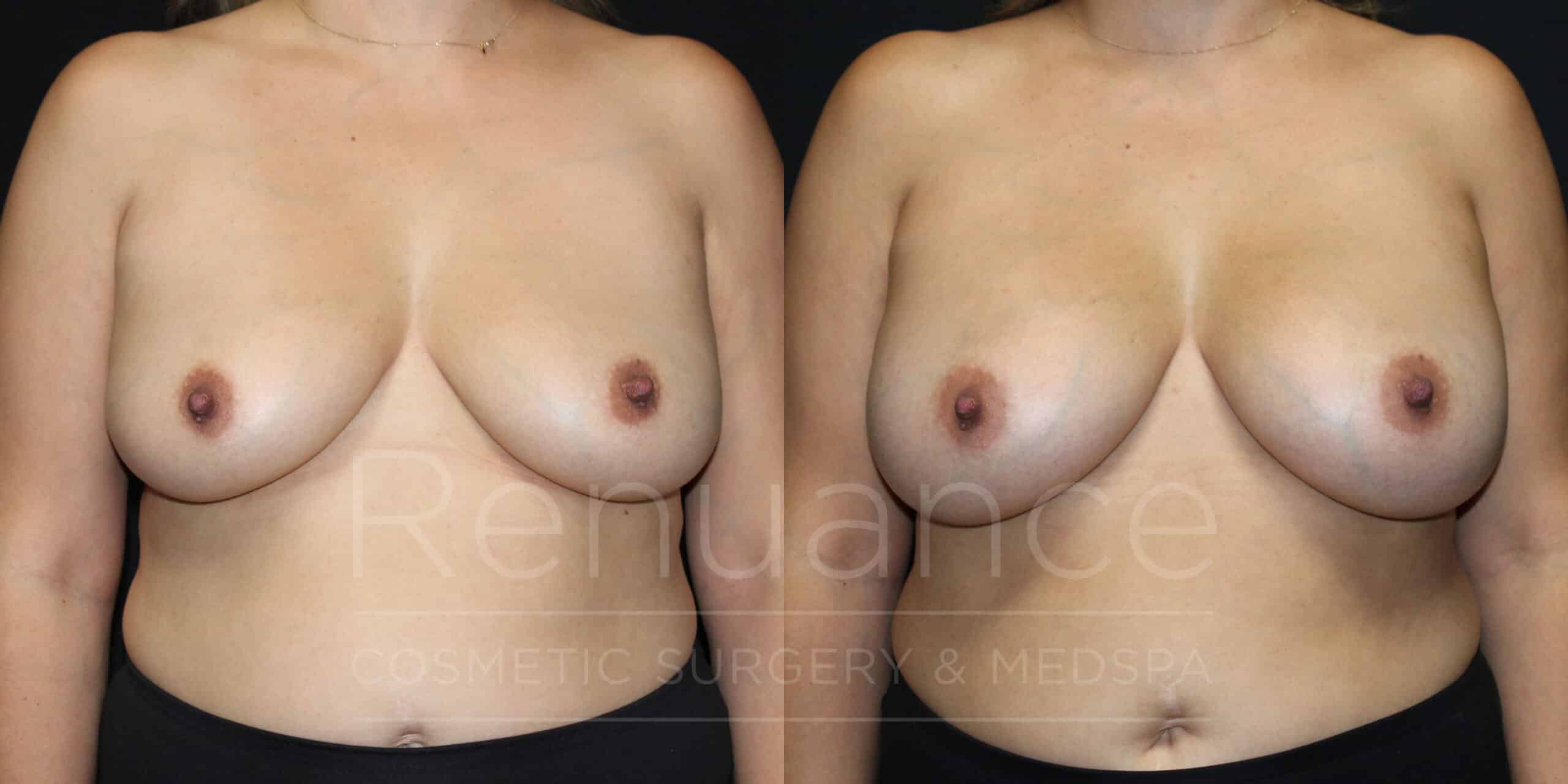 breast augmentation before and after