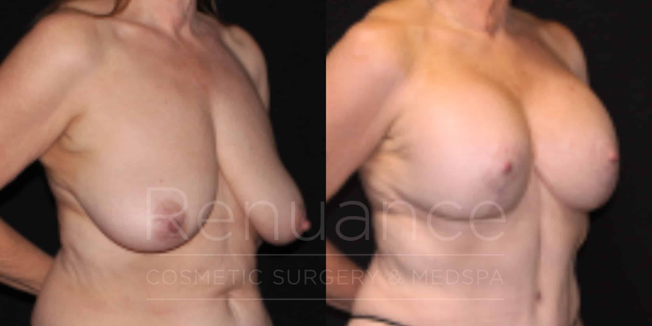 mommy makeover before and after