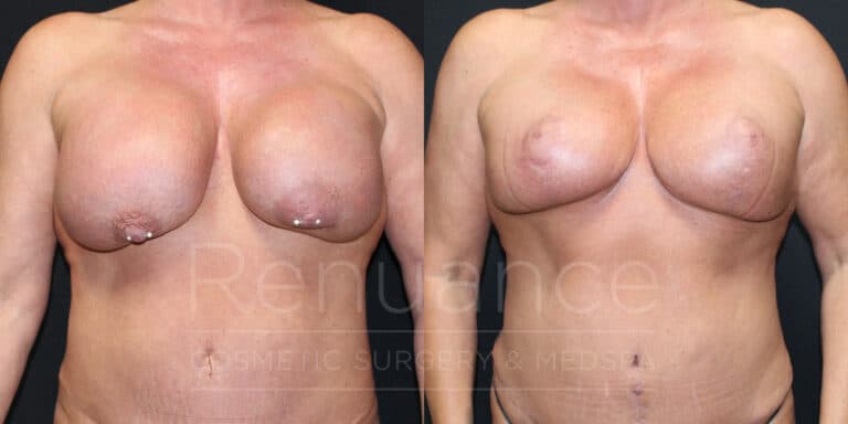 Mommy Makeover- Implant Exchange, Plane Change to Subpectoral, Capsulectomies, Mesh Placement, Mastopexy, Tummy Tuck Revision by Dr. Rachel Ford at Renuance