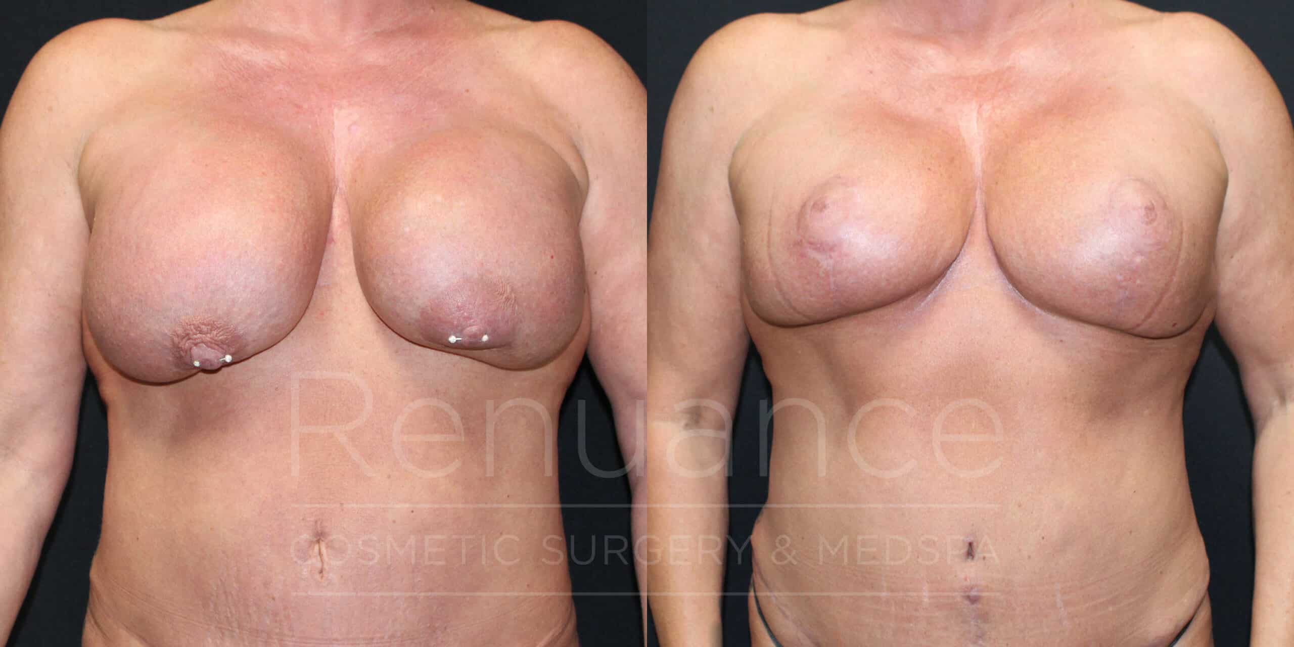 Mommy Makeover- Implant Exchange, Plane Change to Subpectoral, Capsulectomies, Mesh Placement, Mastopexy, Tummy Tuck Revision by Dr. Rachel Ford at Renuance