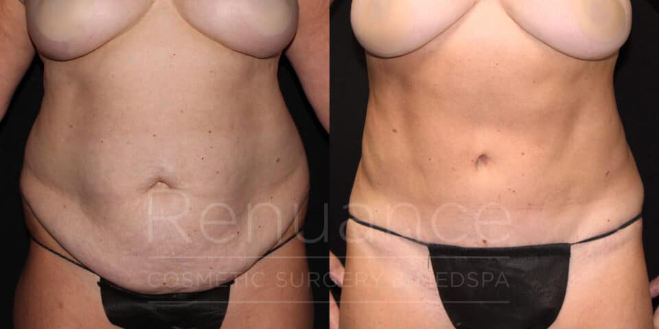 tummy tuck with liposuction before and after