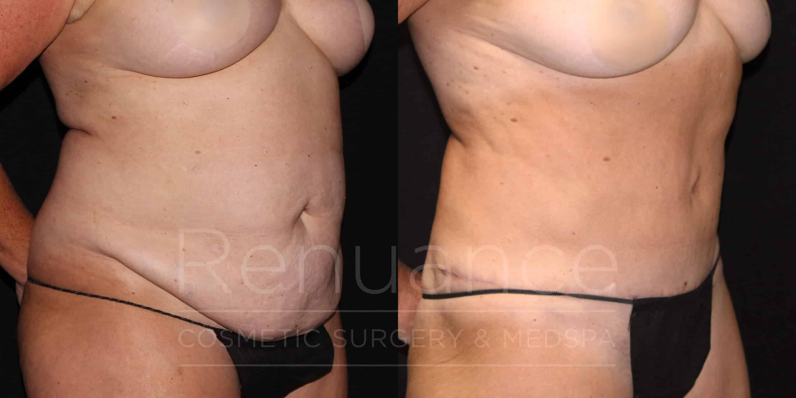 before and after tummy tuck