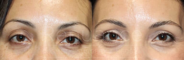blepharoplasty before and after