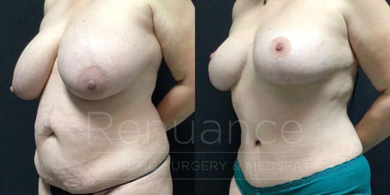 before and after breast reduction