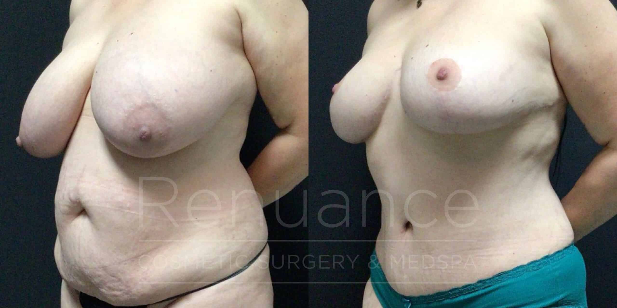 before and after breast reduction