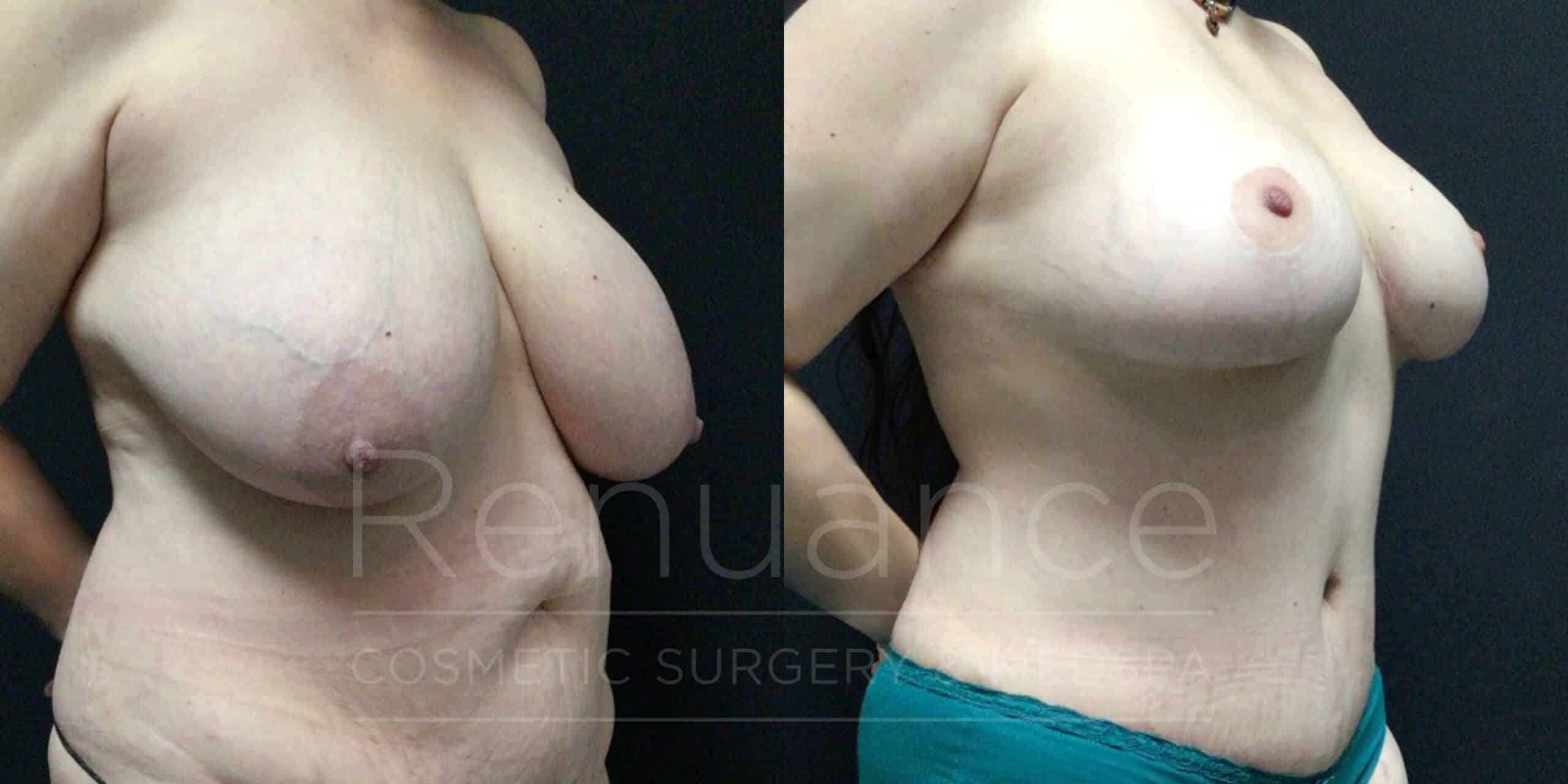 breast reduction before and after