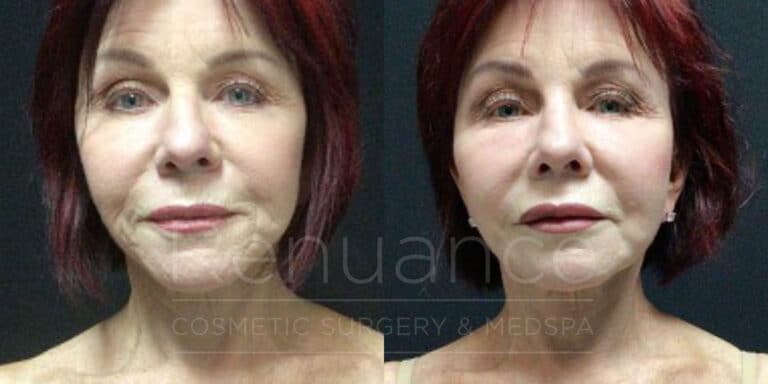 facelift before and after