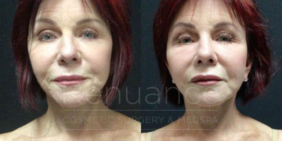 facelift before and after