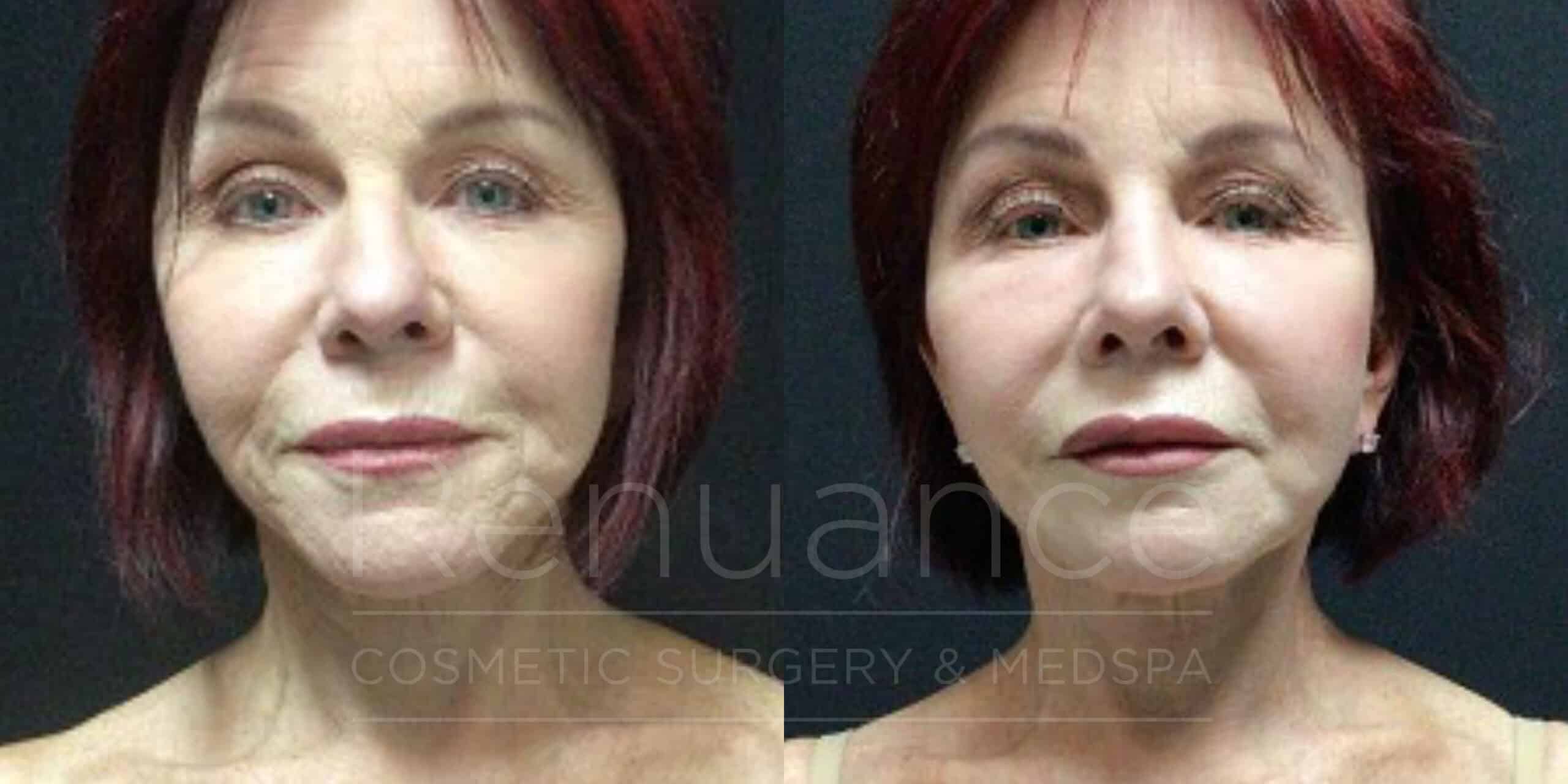 facelift before and after