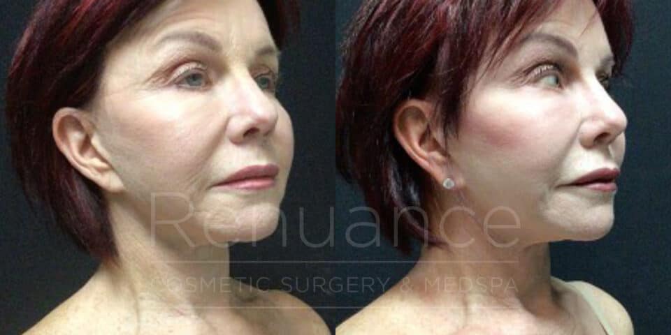 before and after facelift