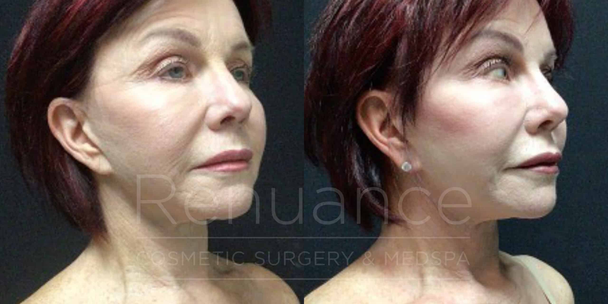 before and after facelift