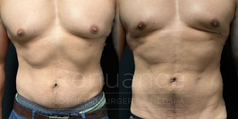before and after gynecomastia