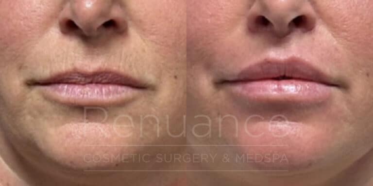 lip lift and fat transfer