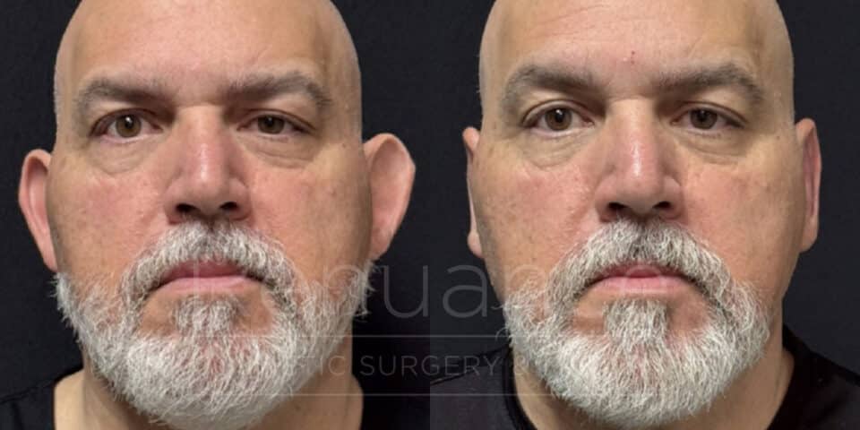 otoplasty before and after