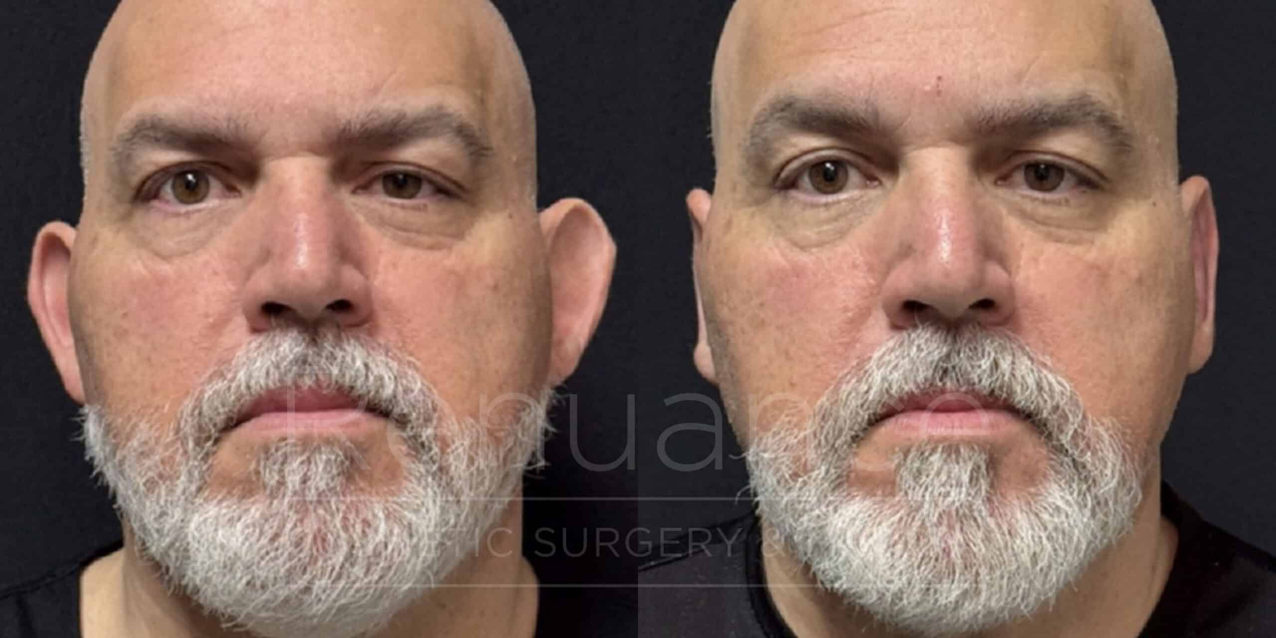 otoplasty before and after
