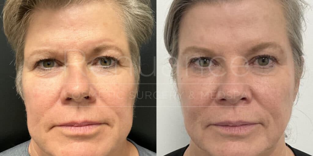 botox before and after and radiesse