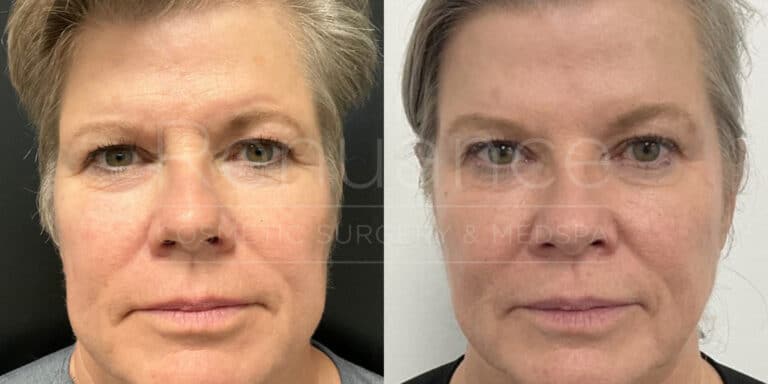 botox before and after and radiesse