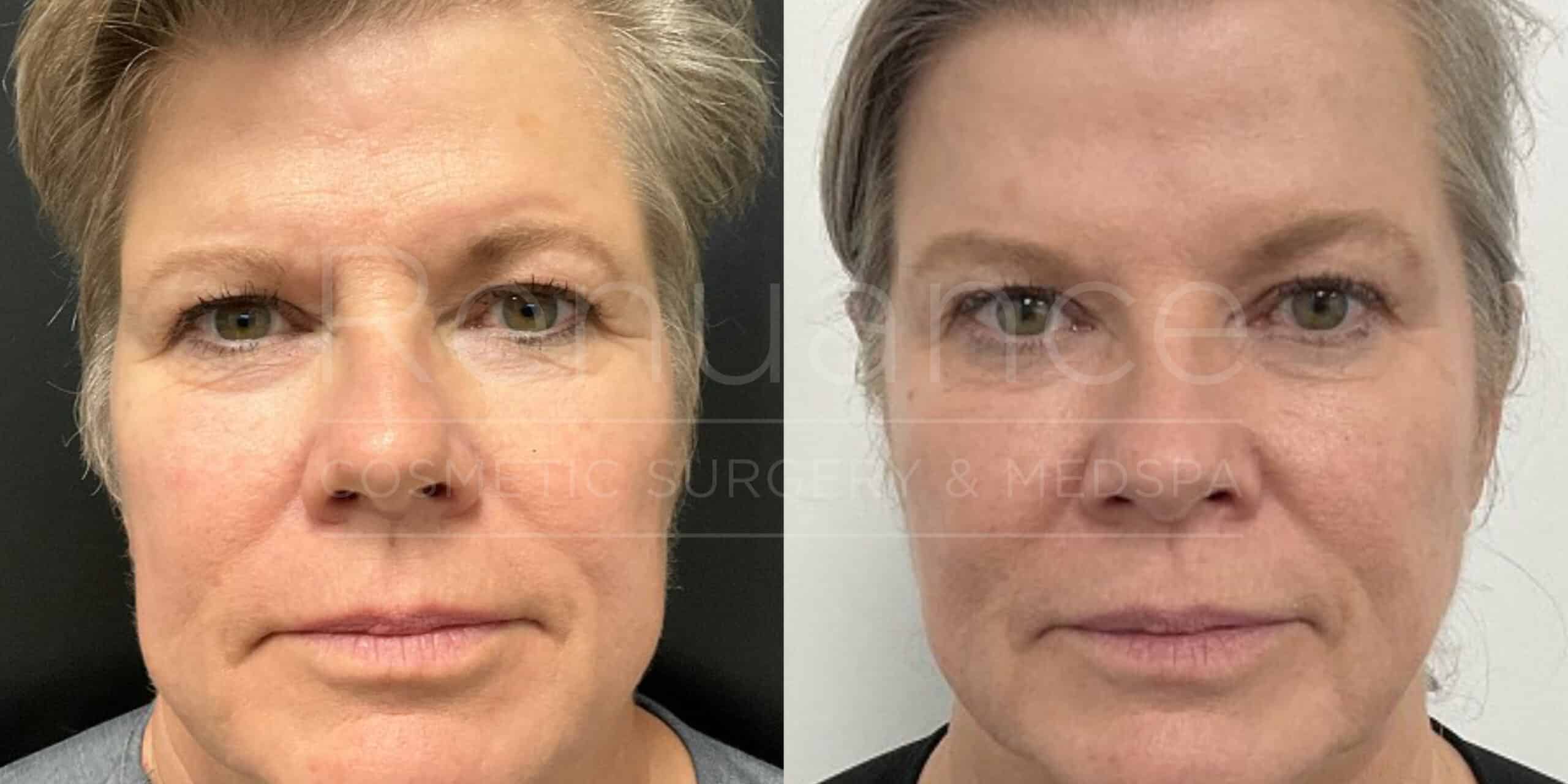 botox before and after and radiesse