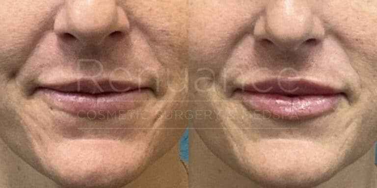 Renuance before and after | Lip filler by Deborah Taurek, MD.