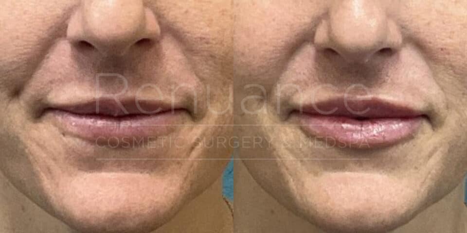 Renuance before and after | Lip filler by Deborah Taurek, MD.