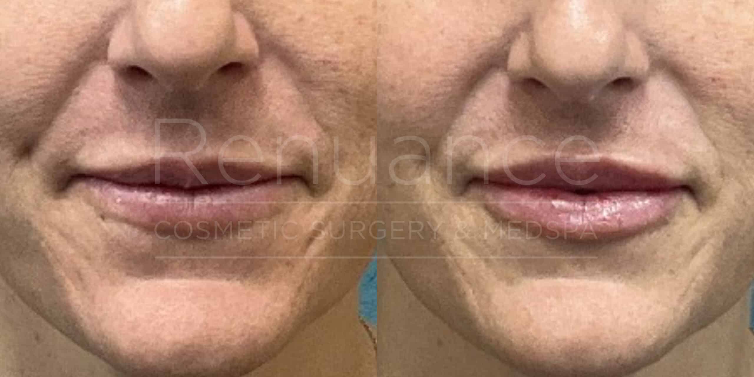 Renuance before and after | Lip filler by Deborah Taurek, MD.