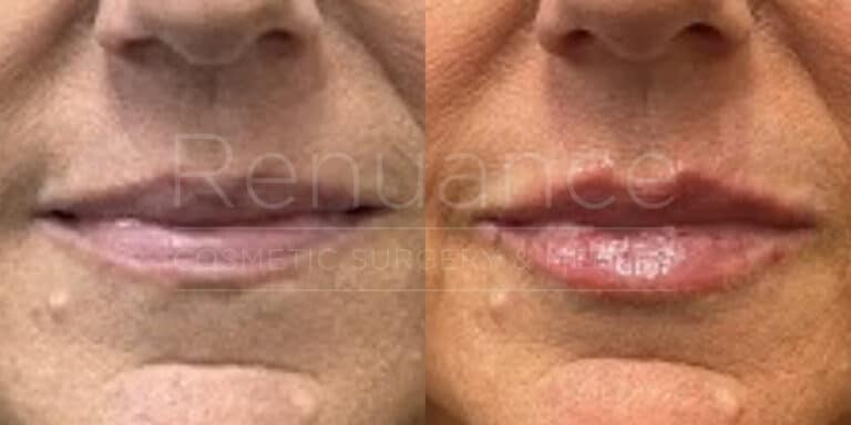Renuance before and after | Lip filler by Chelsea Delaney, RN.