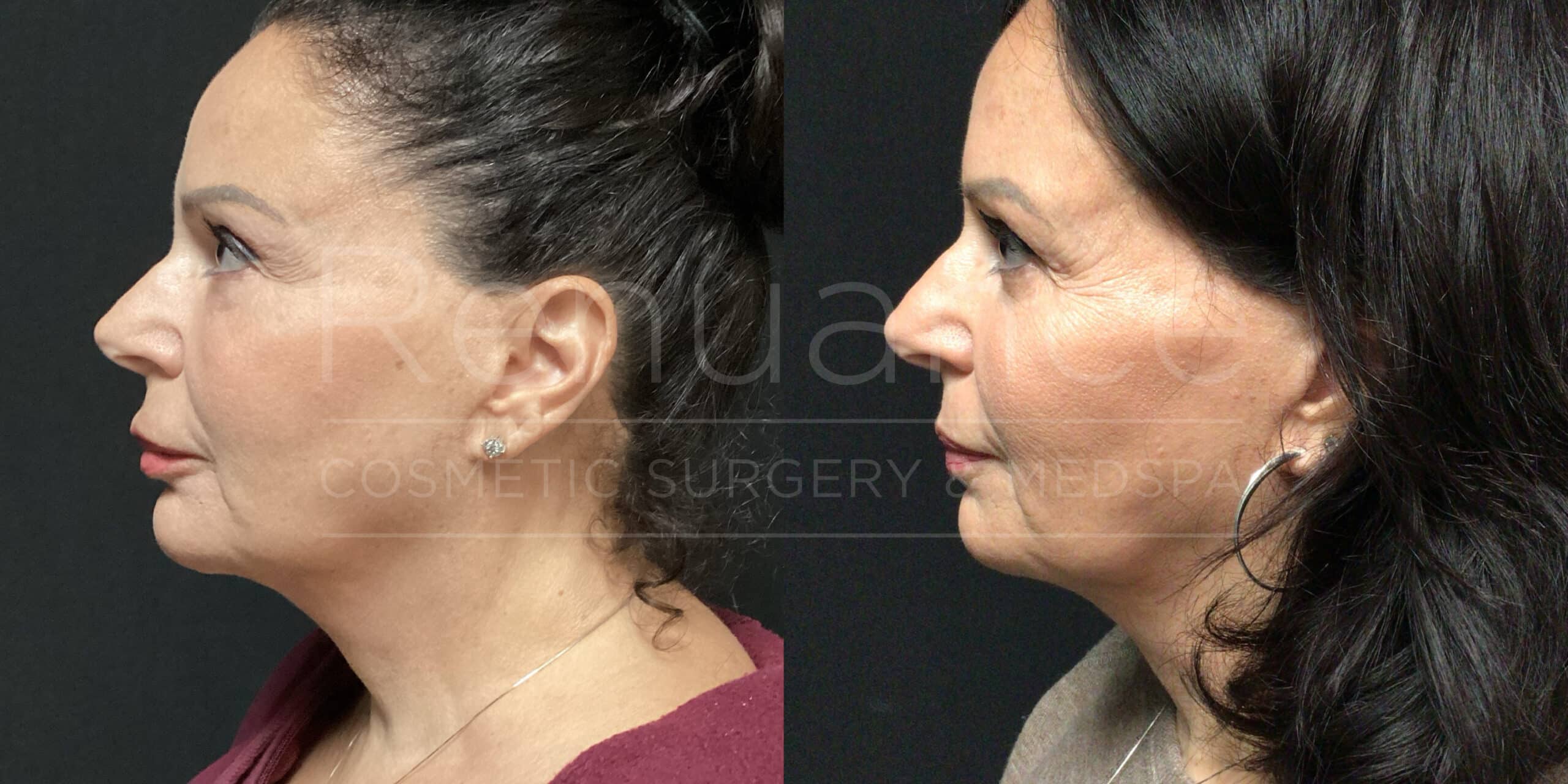 Renuance - Fat Transfer before and after photo - Angle 3