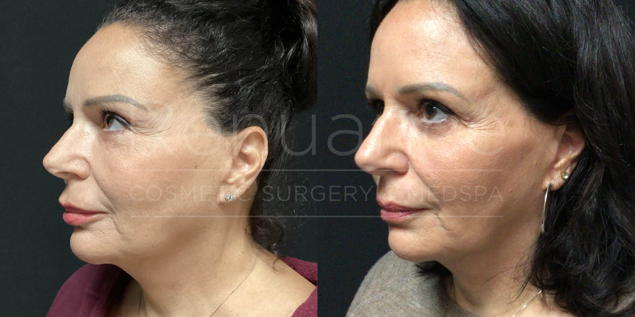 Renuance - Fat Transfer before and after photo - Angle 2