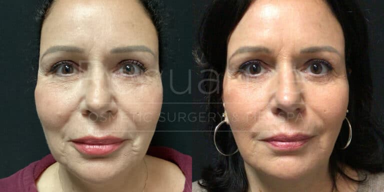 Renuance - Fat Transfer before and after photo - Angle 1