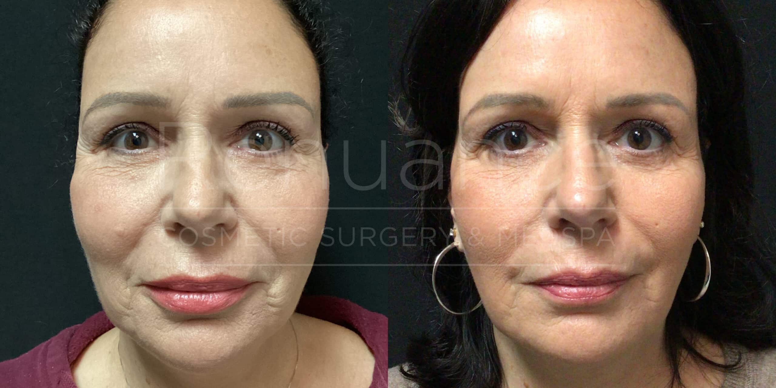 Renuance - Fat Transfer before and after photo - Angle 1