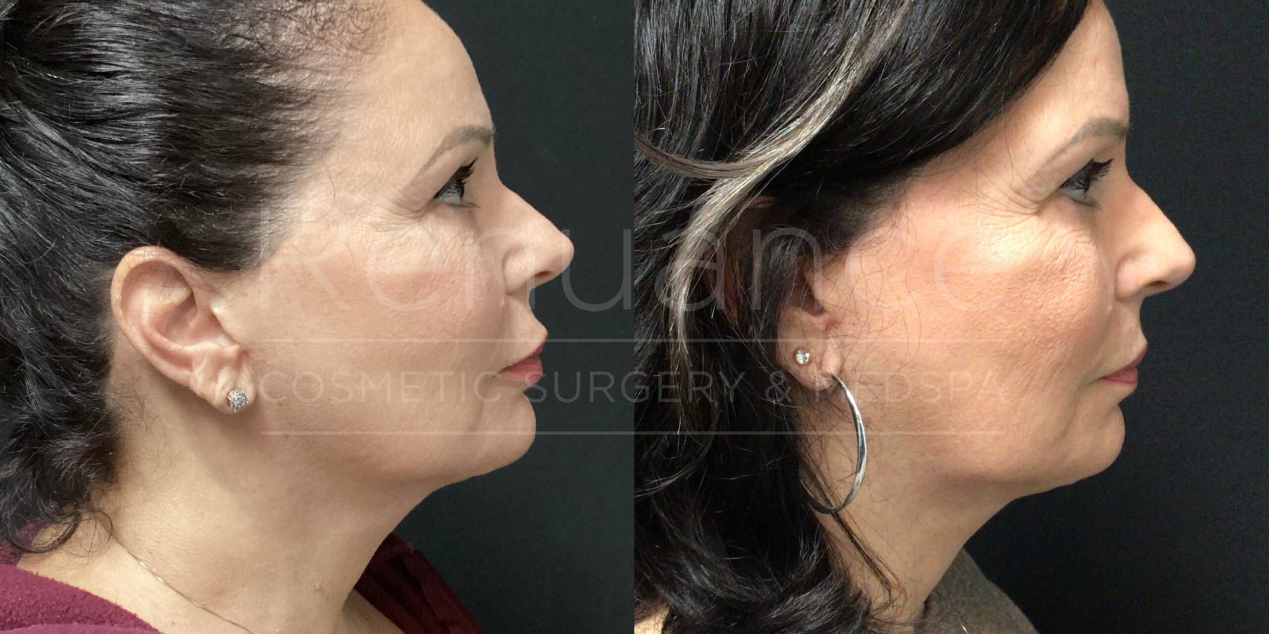 Renuance - Fat Transfer before and after photo - Angle 4