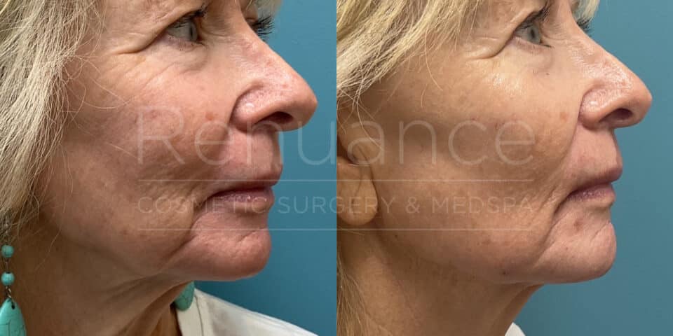 Renuance - Filler before and after photo - Angle 1