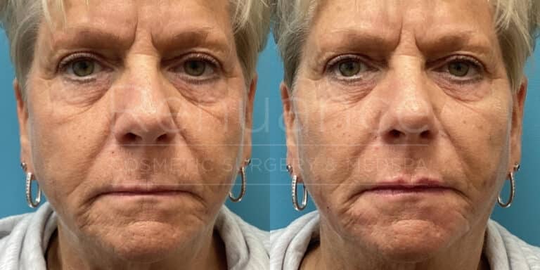 Renuance - Filler to the mid-face before and after photo