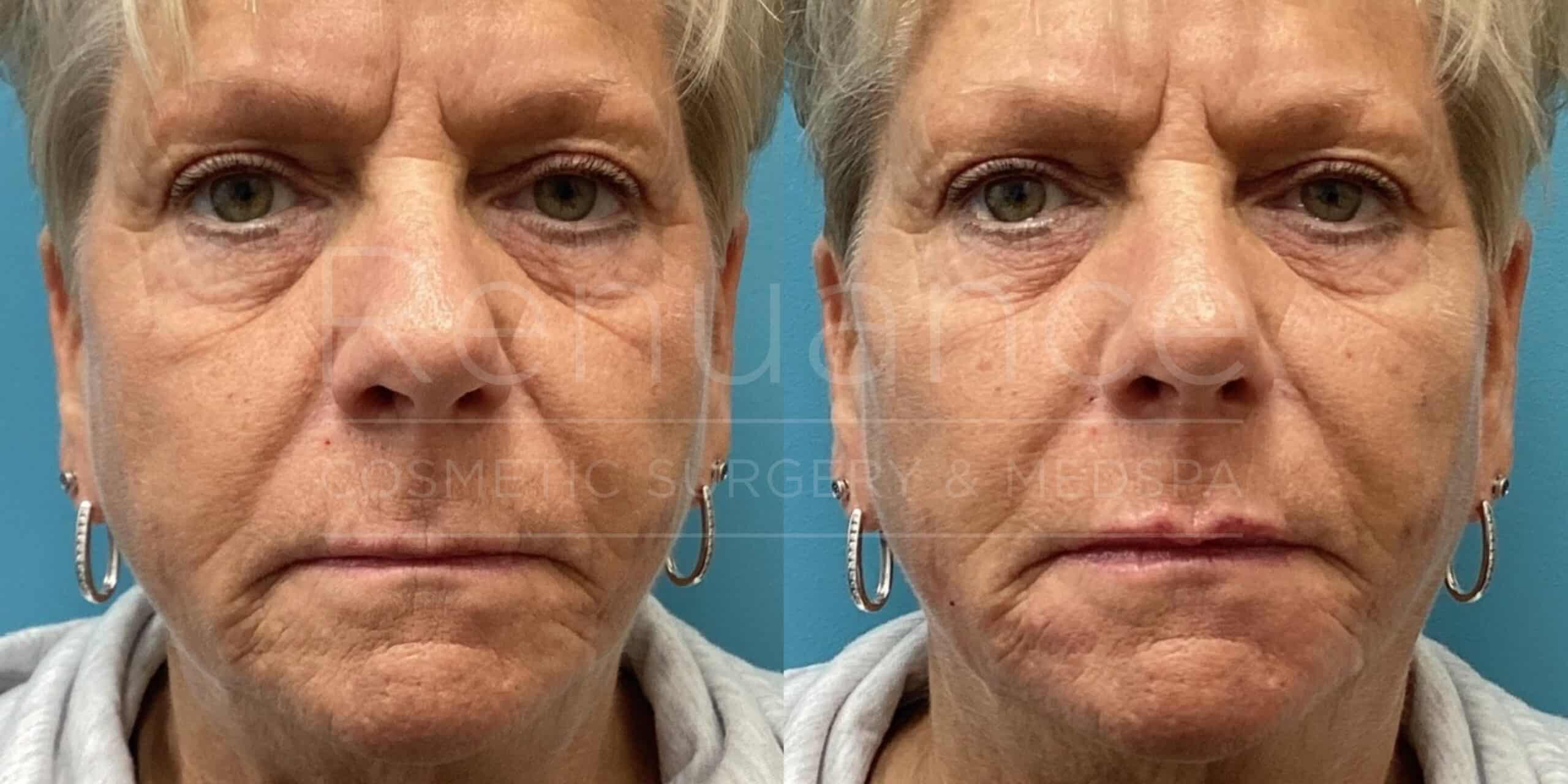 Renuance - Filler to the mid-face before and after photo